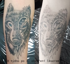 8 týdnu po 1. ošetření laserem