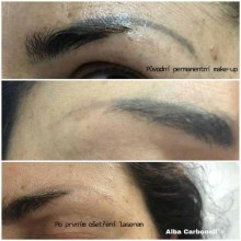 4 týdny po 1 ošetření laserem