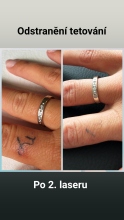 Odstranění tetování po 2. laseru