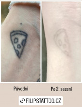 Filips Tattoo, odstranění tetování 