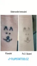 Filips Tattoo, odstranění tetování po 2. sezení 