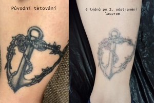 6 týdnů po 2. sezení