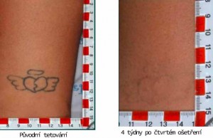 stáří tetování 3 roky, počet ošetření: 4x