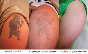 Stáří tetování: 5 let, počet ošetření: 5x
