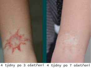 červená barva - 4 týdny po 7. sezení